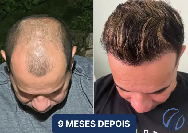 Antes e depois 01