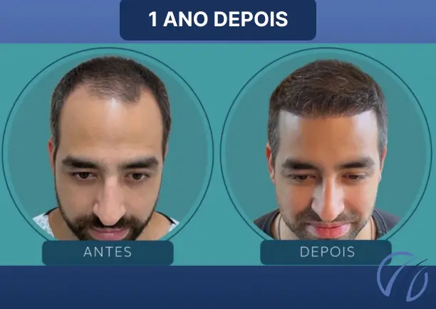 Antes e depois 11