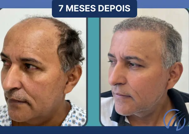 Antes e depois 13