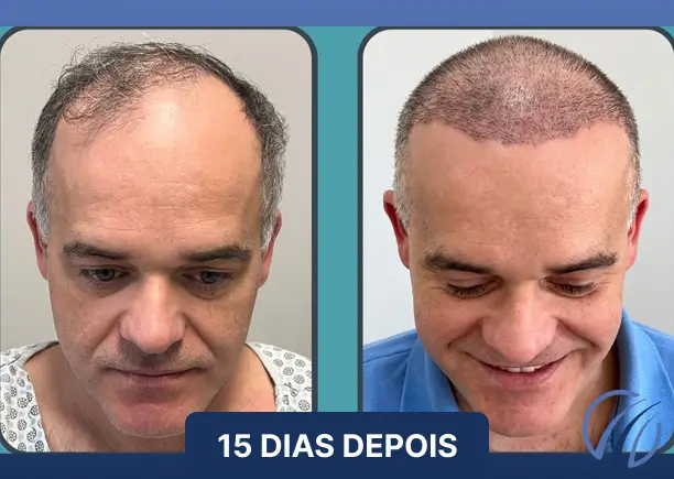 Antes e depois 14