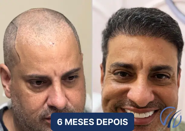 Antes e depois 3