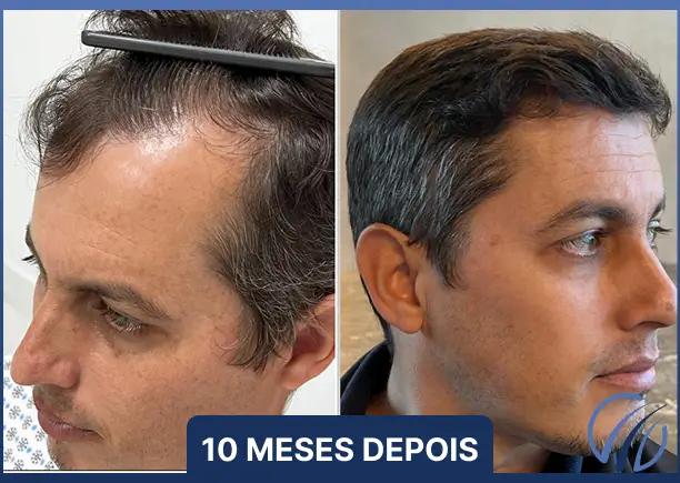 Antes e depois 4