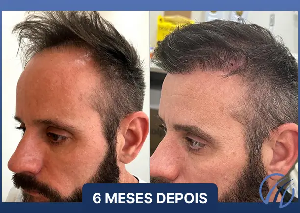 Antes e depois 5